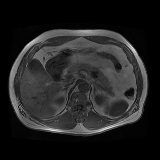 【病例】胰腺囊腺瘤1例MR影像表现