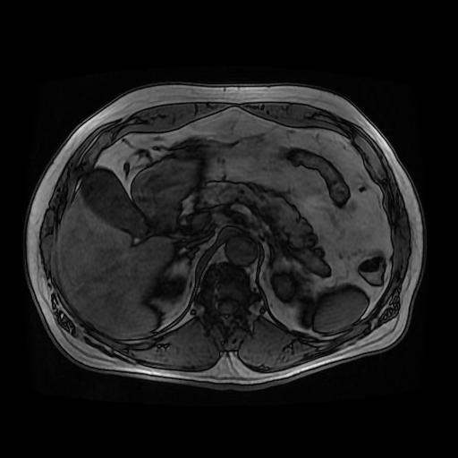 【病例】胰腺囊腺瘤1例MR影像表现