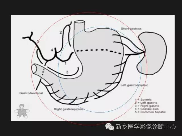 胃癌的影像学分期图解