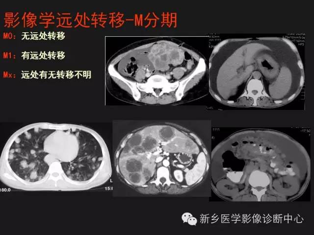 胃癌的影像学分期图解