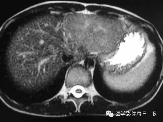 【病例】肝局灶结节样增生1例MR影像表现