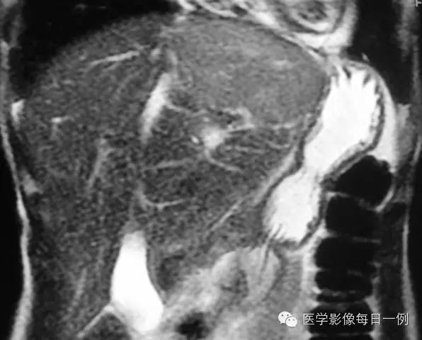 【病例】肝局灶结节样增生1例MR影像表现