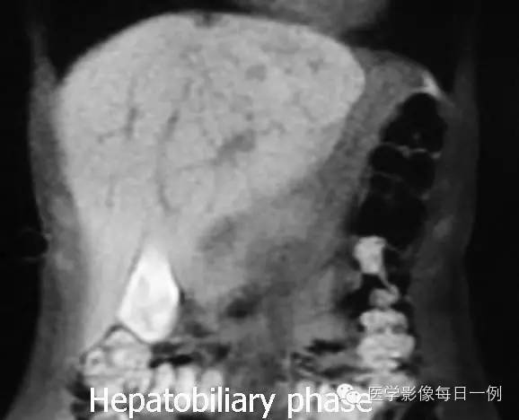 【病例】肝局灶结节样增生1例MR影像表现