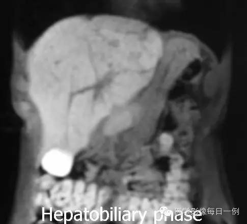 【病例】肝局灶结节样增生1例MR影像表现