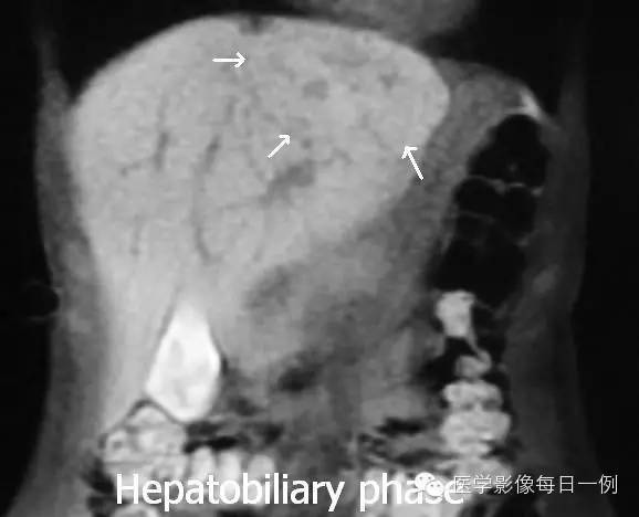 【病例】肝局灶结节样增生1例MR影像表现