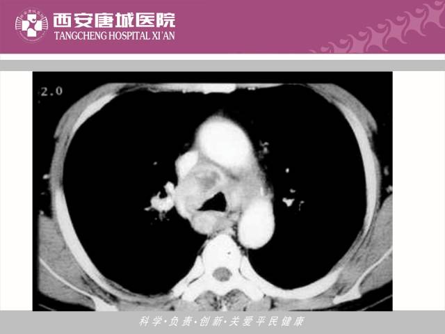【PPT】肺结核影像学诊断与鉴别