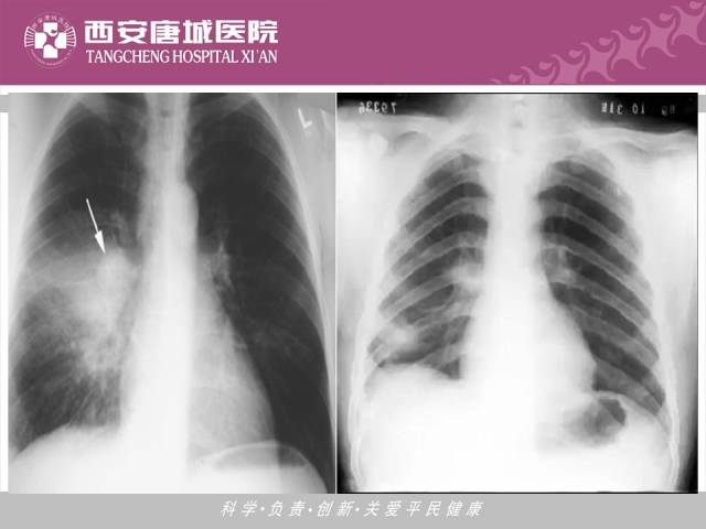 【PPT】肺结核影像学诊断与鉴别