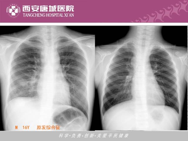 【PPT】肺结核影像学诊断与鉴别