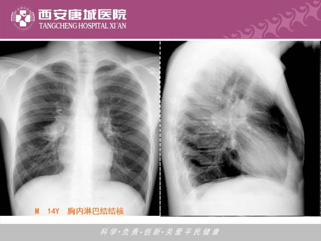 【PPT】肺结核影像学诊断与鉴别