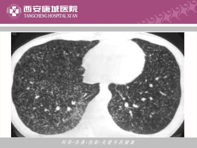 【PPT】肺结核影像学诊断与鉴别