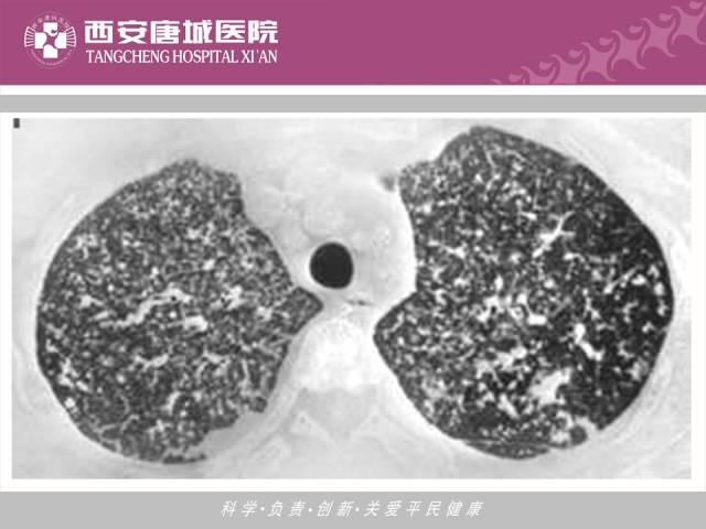 【PPT】肺结核影像学诊断与鉴别