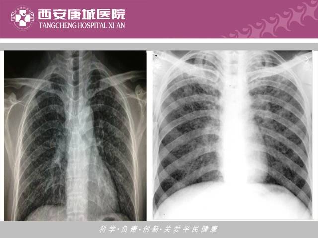 【PPT】肺结核影像学诊断与鉴别
