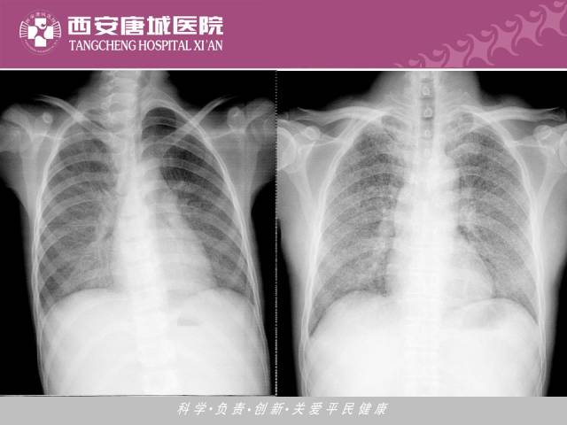 【PPT】肺结核影像学诊断与鉴别