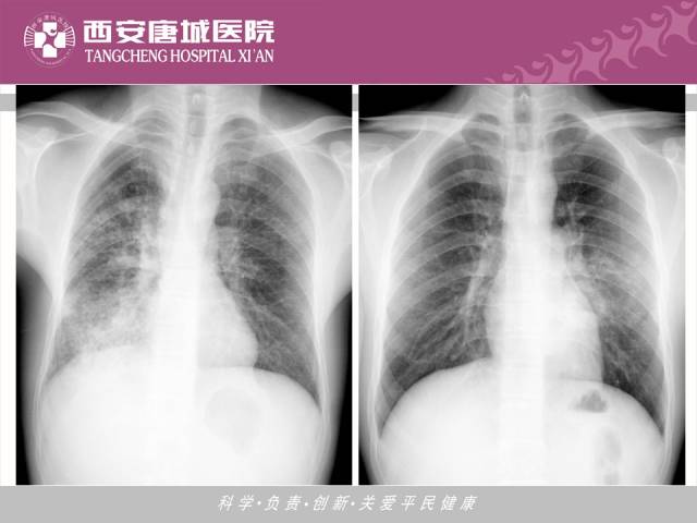 【PPT】肺结核影像学诊断与鉴别