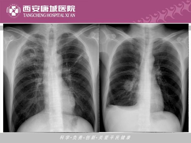 【PPT】肺结核影像学诊断与鉴别