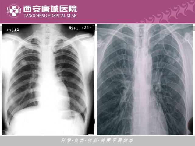 【PPT】肺结核影像学诊断与鉴别