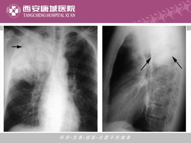 【PPT】肺结核影像学诊断与鉴别