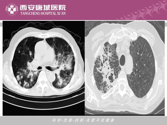 【PPT】肺结核影像学诊断与鉴别