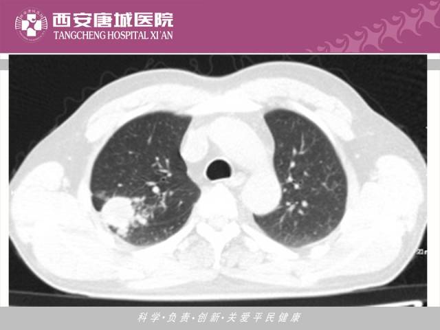 【PPT】肺结核影像学诊断与鉴别