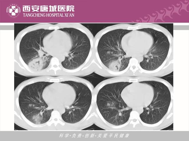 【PPT】肺结核影像学诊断与鉴别