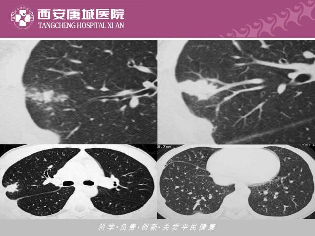 【PPT】肺结核影像学诊断与鉴别