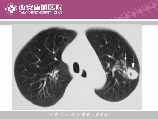 【PPT】肺结核影像学诊断与鉴别