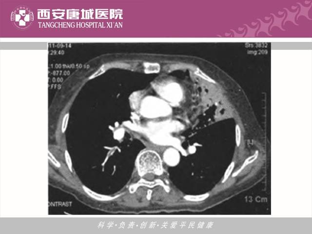 【PPT】肺结核影像学诊断与鉴别