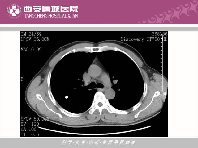 【PPT】肺结核影像学诊断与鉴别