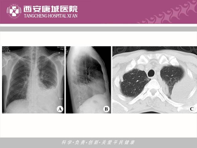 【PPT】肺结核影像学诊断与鉴别
