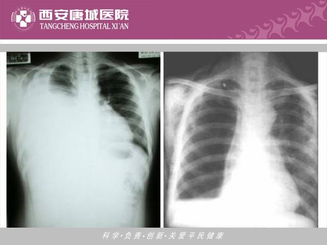 【PPT】肺结核影像学诊断与鉴别