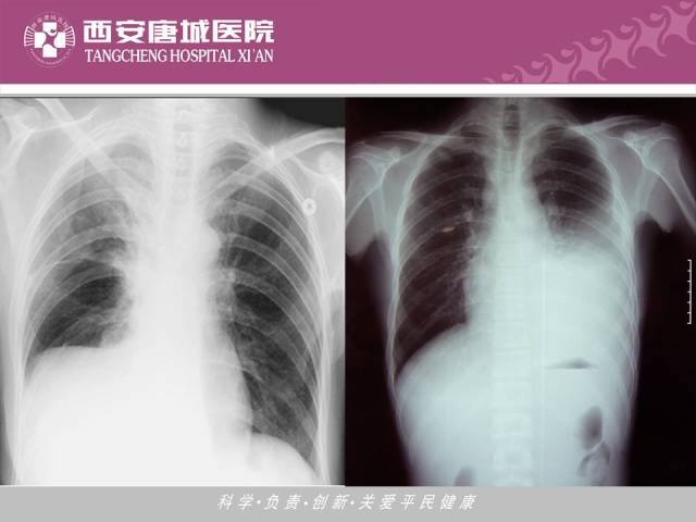 【PPT】肺结核影像学诊断与鉴别