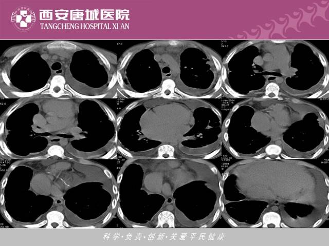 【PPT】肺结核影像学诊断与鉴别