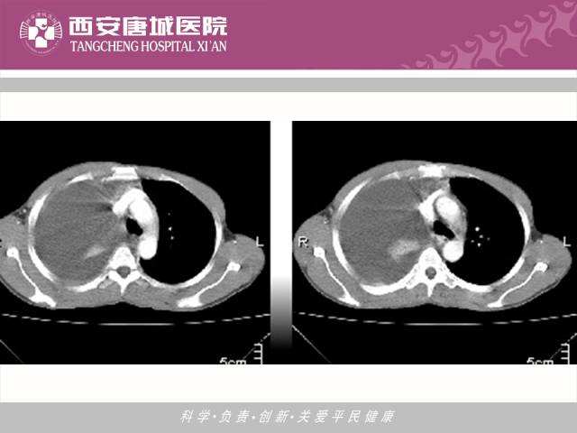 【PPT】肺结核影像学诊断与鉴别