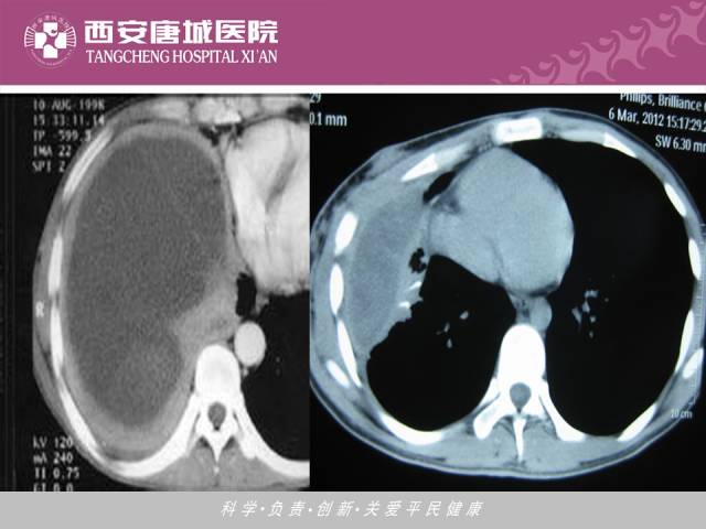 【PPT】肺结核影像学诊断与鉴别