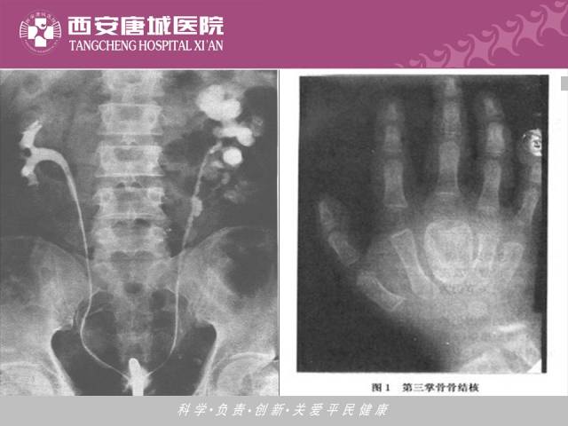 【PPT】肺结核影像学诊断与鉴别