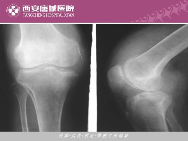 【PPT】肺结核影像学诊断与鉴别