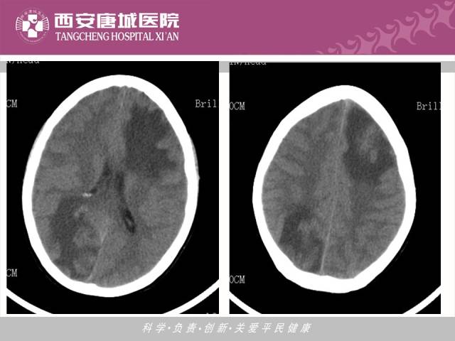 【PPT】肺结核影像学诊断与鉴别