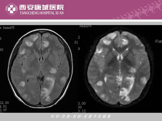 【PPT】肺结核影像学诊断与鉴别