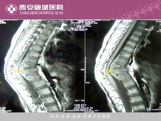 【PPT】肺结核影像学诊断与鉴别