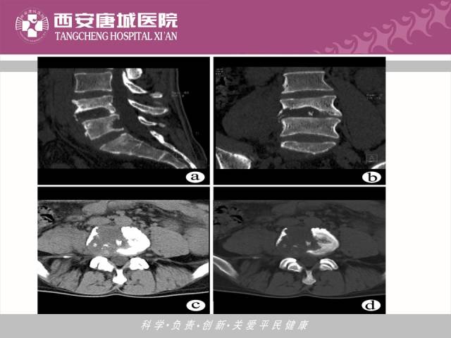 【PPT】肺结核影像学诊断与鉴别