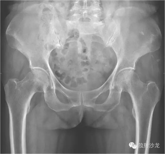 【病例】大块骨质溶解症1例影像表现
