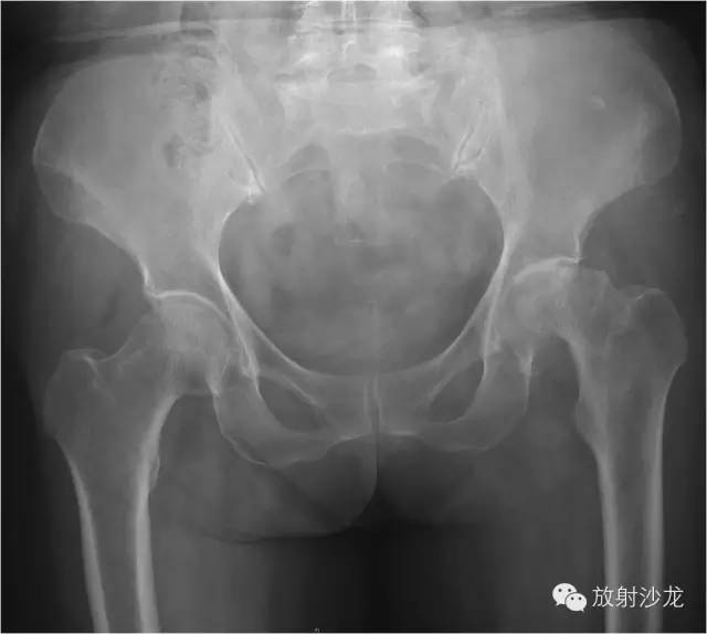 【病例】大块骨质溶解症1例影像表现 【病例】大块骨质溶解症1例影像表现