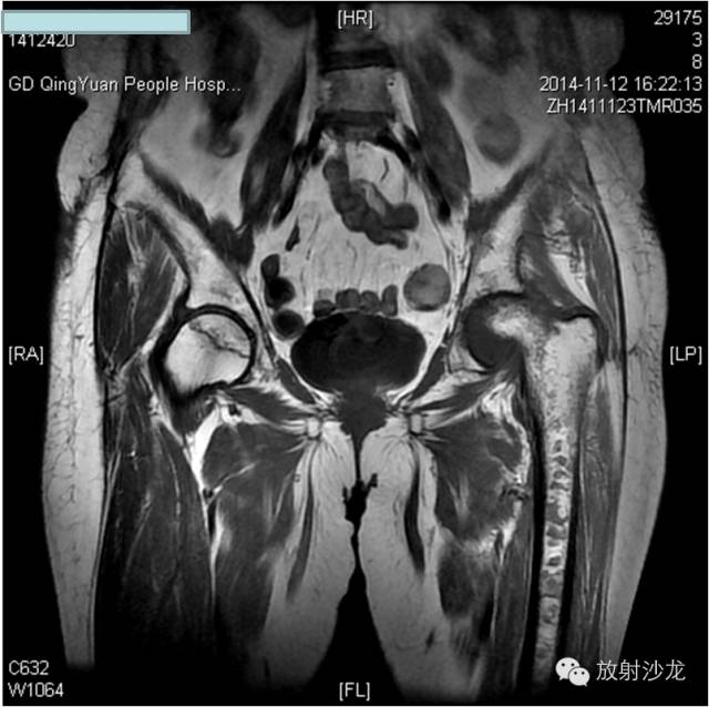 【病例】大块骨质溶解症1例影像表现