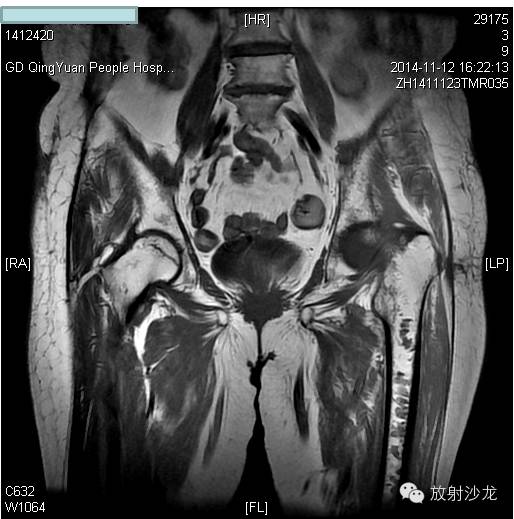 【病例】大块骨质溶解症1例影像表现 【病例】大块骨质溶解症1例影像表现