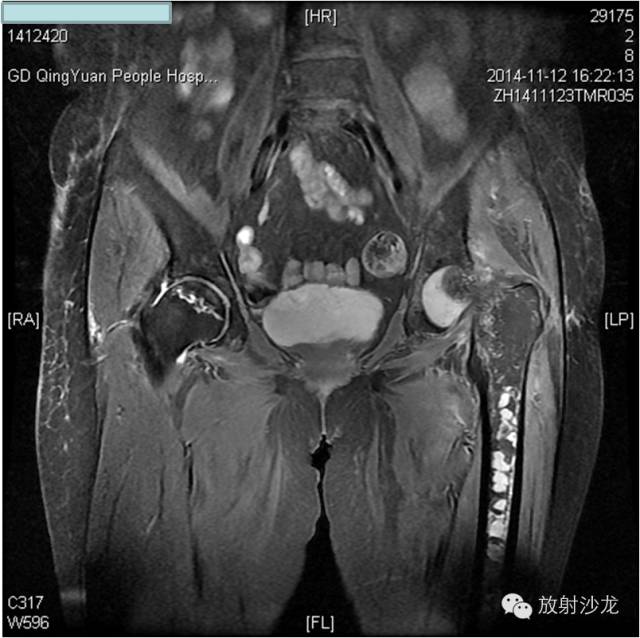 【病例】大块骨质溶解症1例影像表现 【病例】大块骨质溶解症1例影像表现