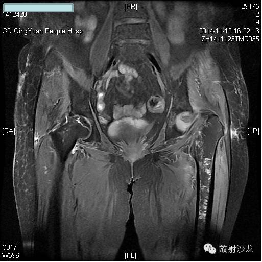 【病例】大块骨质溶解症1例影像表现 【病例】大块骨质溶解症1例影像表现