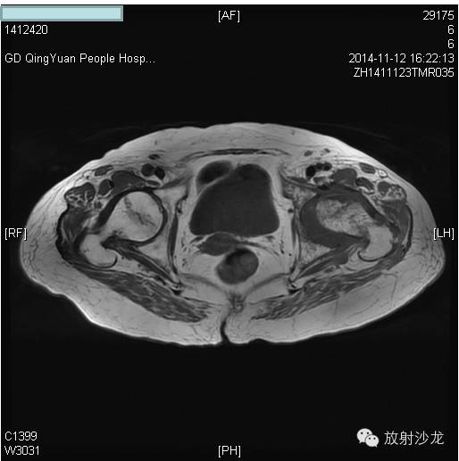 【病例】大块骨质溶解症1例影像表现 【病例】大块骨质溶解症1例影像表现