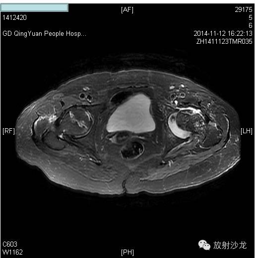 【病例】大块骨质溶解症1例影像表现 【病例】大块骨质溶解症1例影像表现