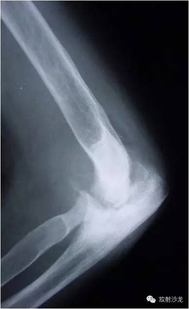 【病例】大块骨质溶解症1例影像表现 【病例】大块骨质溶解症1例影像表现