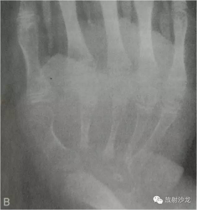 【病例】大块骨质溶解症1例影像表现 【病例】大块骨质溶解症1例影像表现